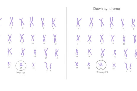 Sindrome di Down, nuovi geni legati alla disabilità intellettiva