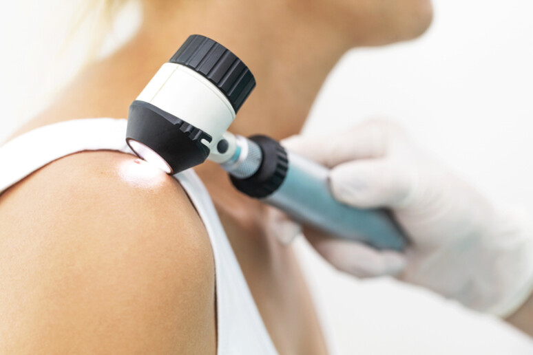 Melanoma, +30% di diagnosi nel 2024 ma cresce l 'immunoterapia - RIPRODUZIONE RISERVATA