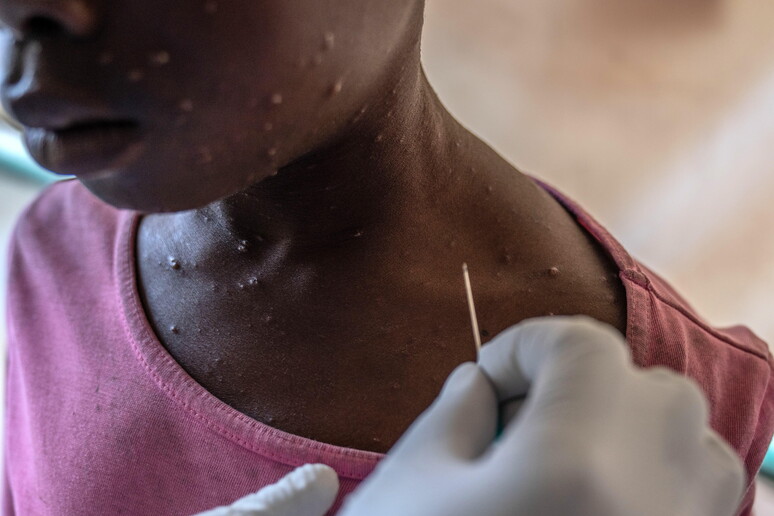 África precisa de 10 milhões de doses de vacina para conter mpox © ANSA/EPA